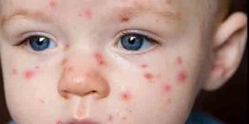 Çoçuklarda Kızamık Hastalığı Belirtileri ve Tedavisi