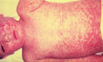 Kızamıktan Korunma Yolları